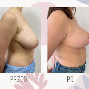 efekt zmniejszenia i podniesienia piersi po zabiegu mastopeksji
