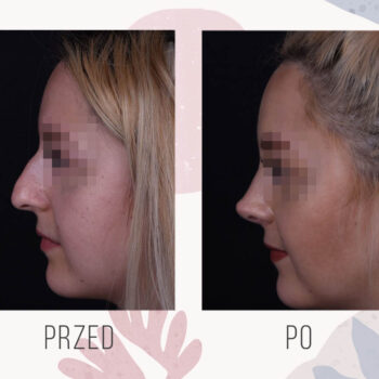 korekcja nosa zdjęcia przed i po