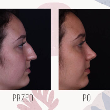 efekt przed i po zabiegu plastyki nosa