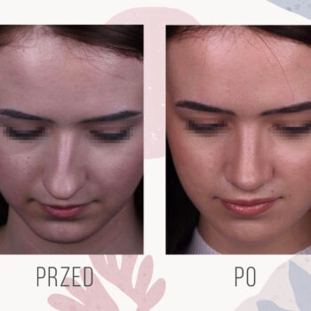 efekt po zabiegu korekty nosa