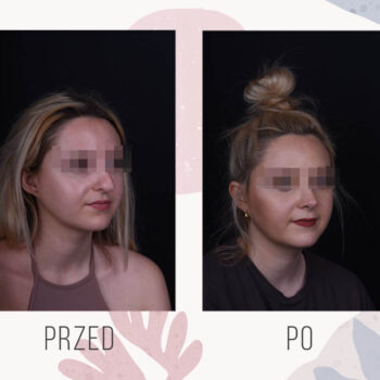 korekta nosa efekt przed i po