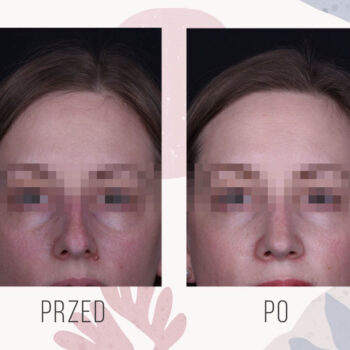 operacja nosa efekt przed i po