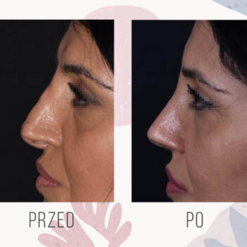 korekta nosa PIEZO efekt przed i po