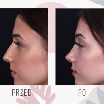 efekt po zabiegu plastyki nosa