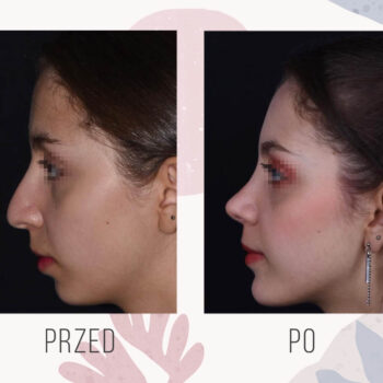 operacja plastyczna nosa przed i po