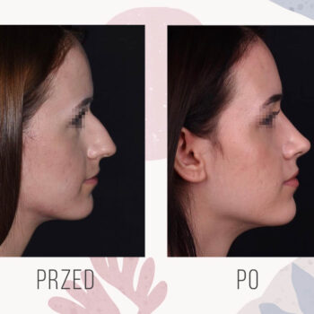 efekt przed i po operacji plastycznej nosa