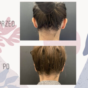 plastyka odstających uszu