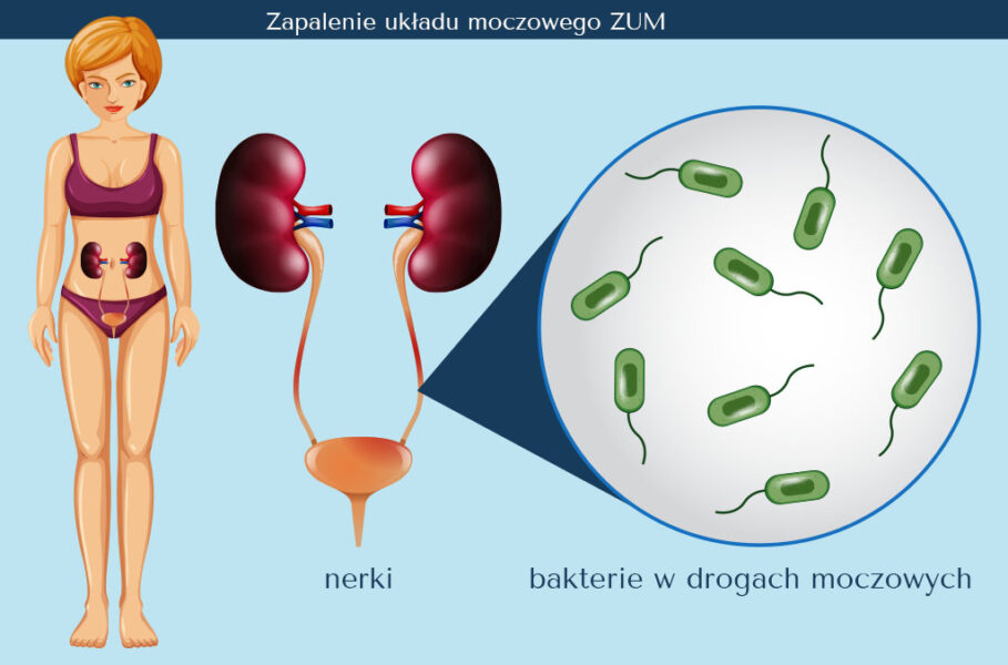 Zakażenie Układu Moczowego Zum Przyczyny I Leczenie 7728