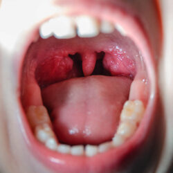 tonsillotomia
