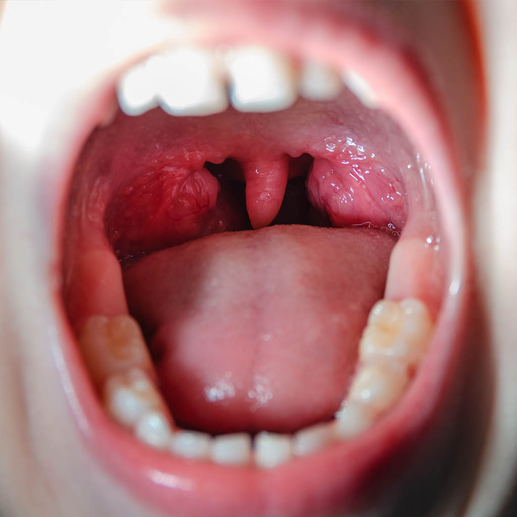 tonsillotomia