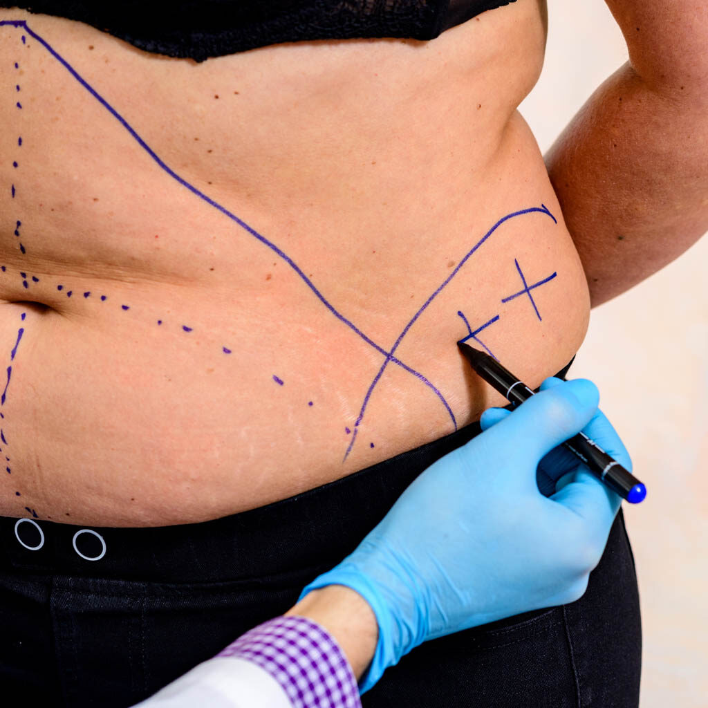 abdominoplastyka brzucha