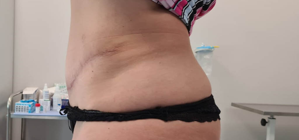 efekt po zabiegu abdominoplastyki brzucha