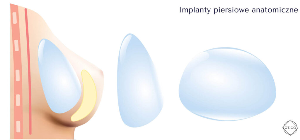 implanty piersiowe anatomiczne
