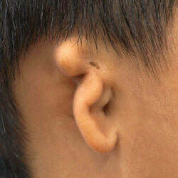kalafiorowe ucho