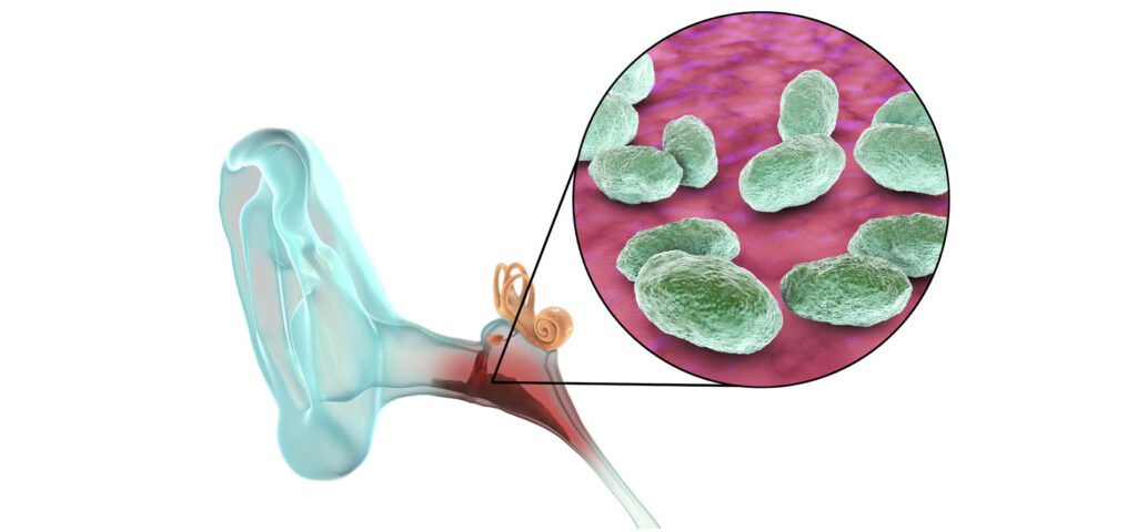 zapalenie ucha wewnetrznego wywolane przez bakterie