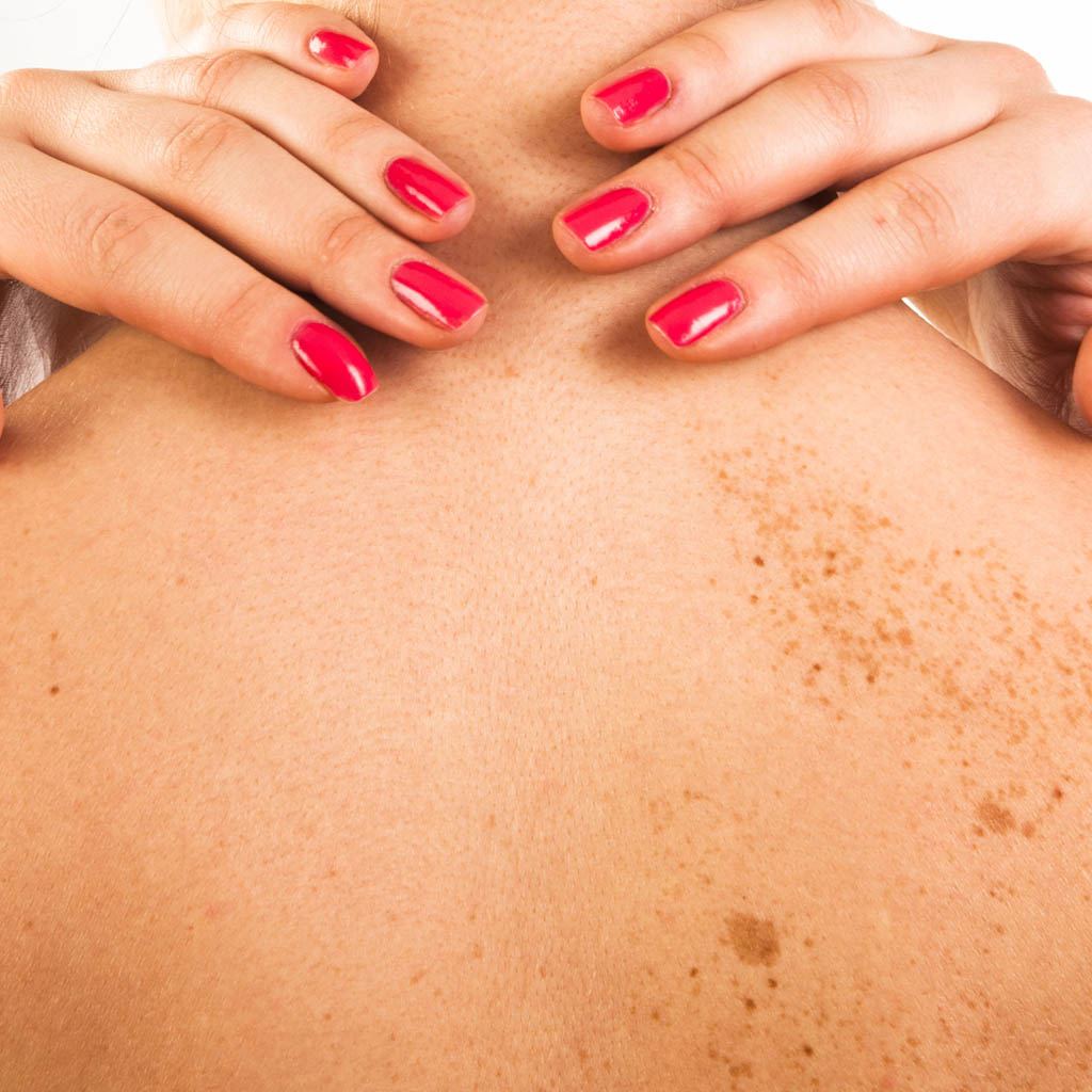 zabiegi dla kobiet po ciazy z melasma zabiegi dla kobiet po ciazy z melasma