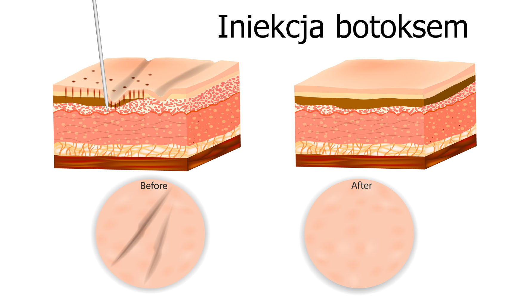 iniekcja botoksem