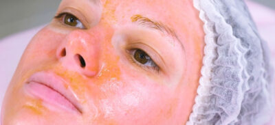 peeling fenolowy