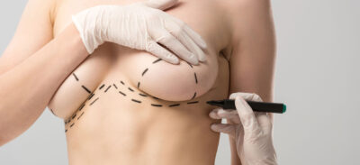 blizny po operacjach piersi