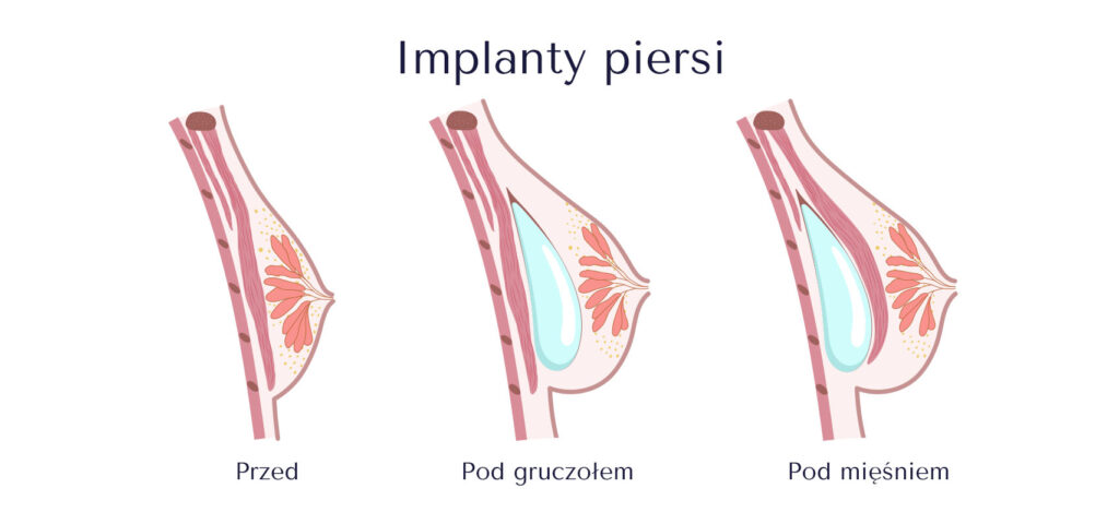 implanty piersiowe umiejscowienie