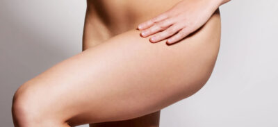 bryczesy na udach – nadmiar tkanki tłuszczowej w bocznej części ud