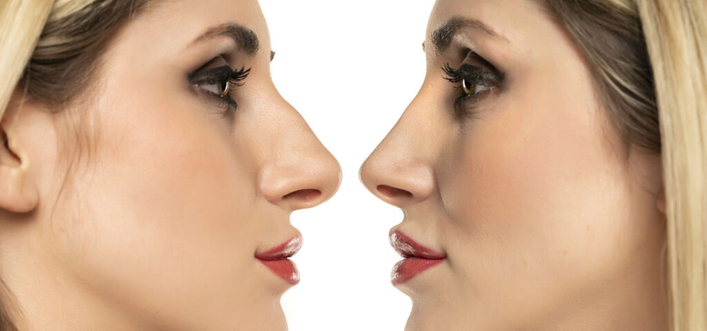 korekcja nosa profil przed i po operacji