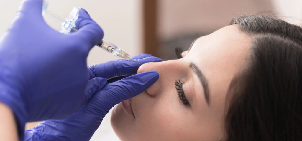 Korekta nosa bez operacji – efekt modelowania Modelowanie nosa kwasem hialuronowym bez operacji