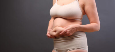 Kobieta pokazująca różnicę między fałdem tłuszczu a wiotką skórą na brzuchu