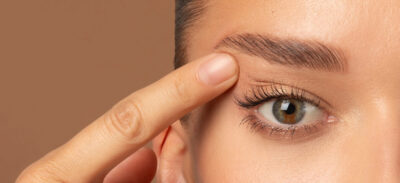 Przykład zaawansowanego nadmiaru skóry powiek górnych