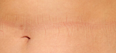 Umiejscowienie blizny po abdominoplastyce