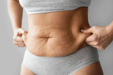 ROZEJŚCIE MIĘŚNI BRZUCHA A ABDOMINOPLASTYKA